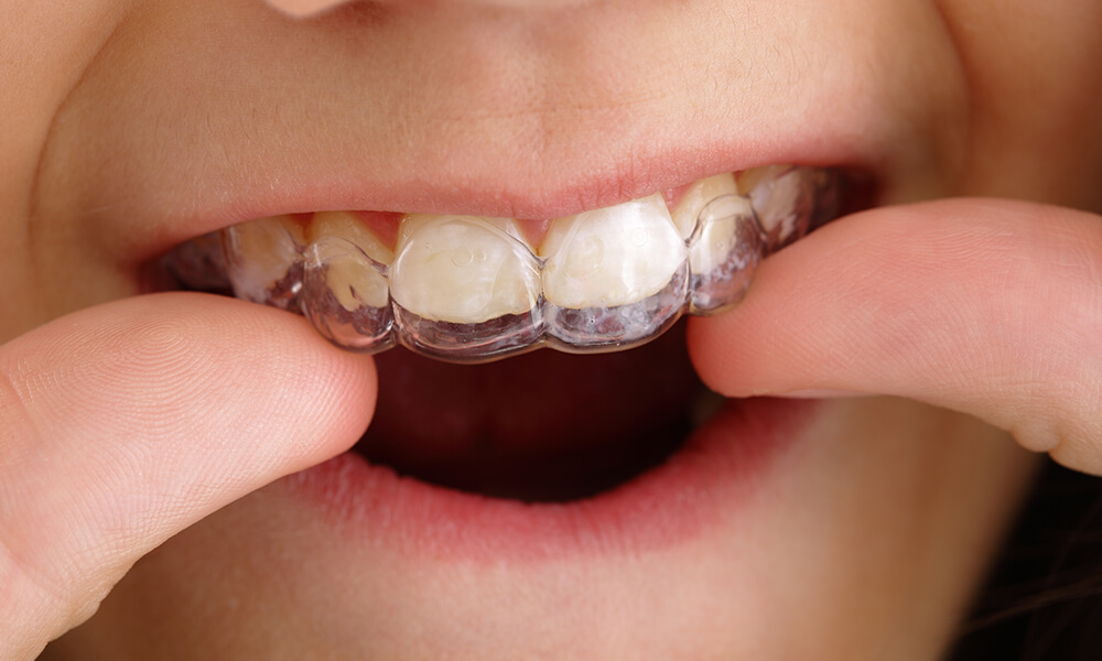 blog-straight-smile.jpg